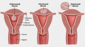 Fibroid removal surgery cost depend on invasive is surgery