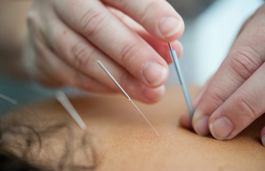 Can accupuncture treat infertility