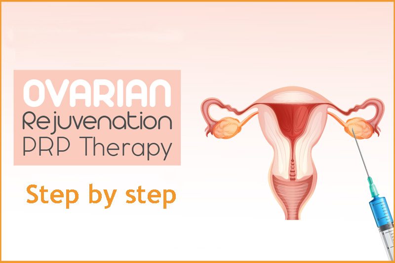 Ovarian Rejuvenation Treatment with PRP